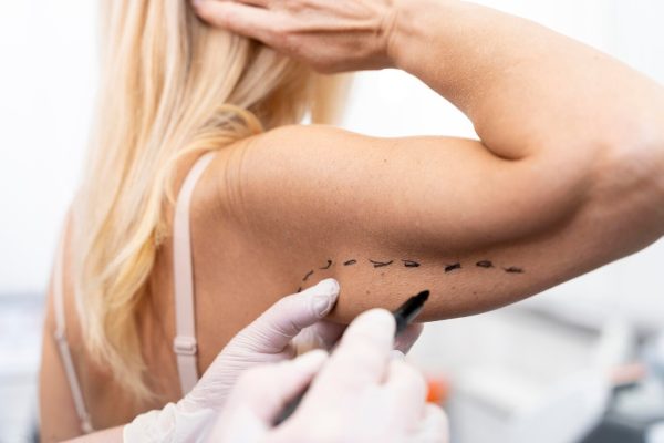 Lipoaspiratie brate BodyTite