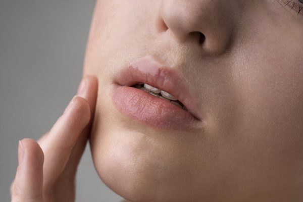 Lip lift