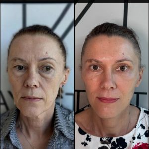 Vertical restore facelift